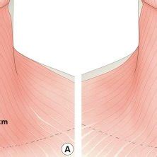 Schematic illustration of scar adhesion (A) The scar adhesion from the... | Download Scientific ...