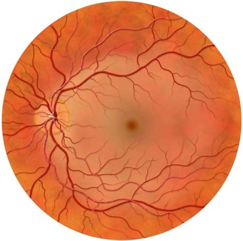 Central Retinal Artery Occlusion Vs Normal