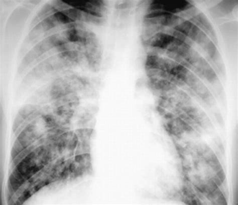 Fungal pneumonia causes, symptoms, diagnosis & treatment