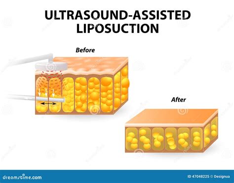 Ultrasound Assisted Liposuction Stock Vector Image 47048225