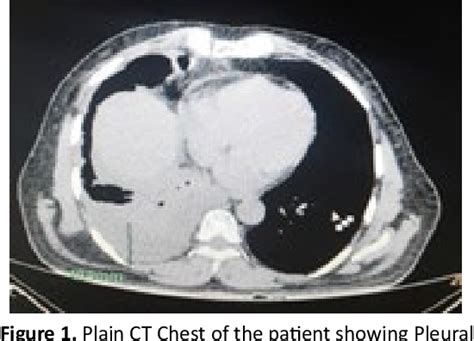 Figure 1 From Community Acquired Methicillin Resistant Staphylococcus Aureus Pneumonia And