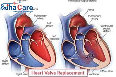 Heart Valve Repair Heart Valve Replacement Edhacare