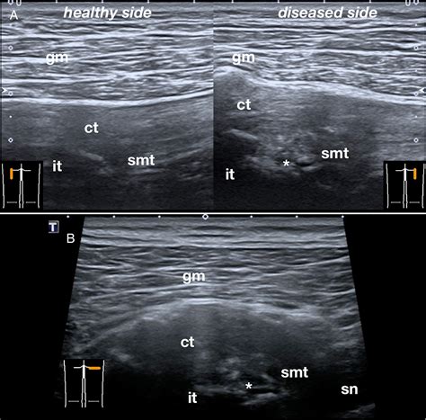 Proximal Hamstring Ultrasound