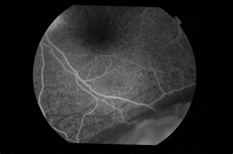 Vkh Disease Retina Image Bank