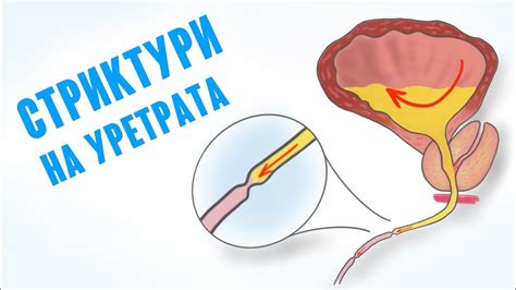 Стриктури на уретрата и трудното уриниране - YouTube
