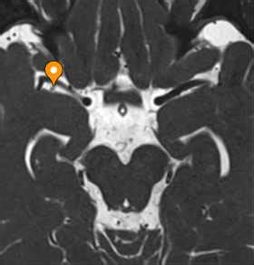 Cistern of cerebral vallecula - e-Anatomy - IMAIOS