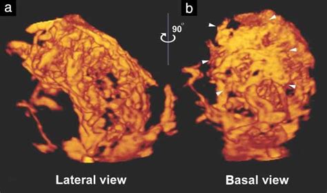 Role Of Three‐dimensional Power Doppler In The Antenatal Diagnosis Of Placenta Accreta