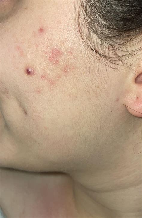 Cystic Acne Scars Help R Skincareaddicts