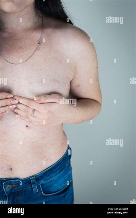 Orticaria Pruriginosa Immagini E Fotos Stock Alamy