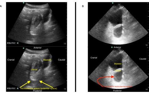 Focused Assessment With Sonography For Trauma Fast Exam Image