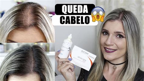 Queda De Cabelo Rem Dios Que Estou Usando Ano De Tratamento Youtube