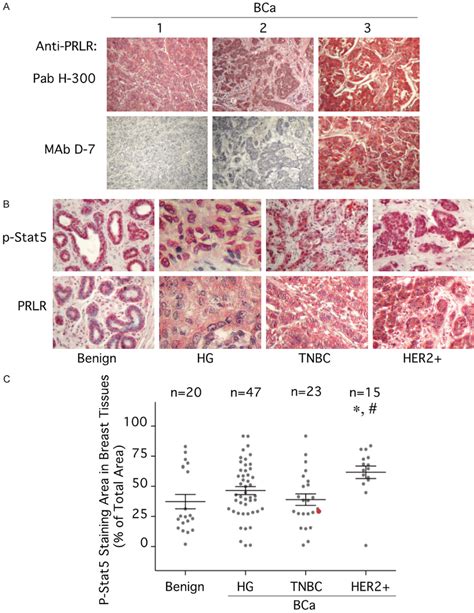 Prlr And Phospho Stat5 Stainings Are High In Benign And Malignant