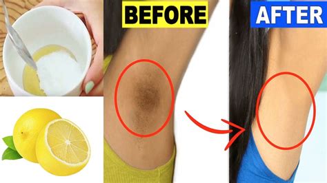 How To Get Rid Of Dark Underarms Overnight।। Underarms Whitening At Home Youtube