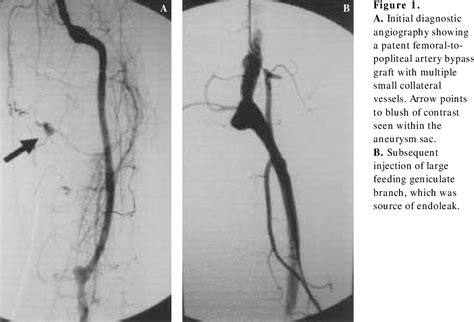 Figure 1 From Endovascular Treatment Of An Endoleak Causing Rupture Of