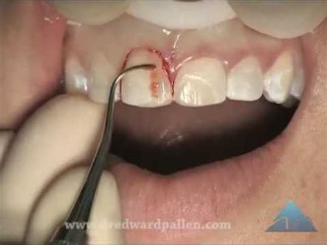esthetic crown lengthening  apically positioned flap youtube