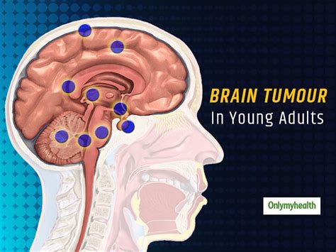 Brain Tumor In Adults What Are The Causes And Risk Factors Related To It Onlymyhealth