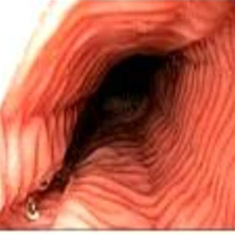 Eosinophilic Esophagitis Endoscopic Appearance Of Esophageal Mucosa