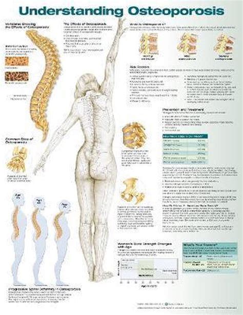 Understanding Osteoporosis Bol