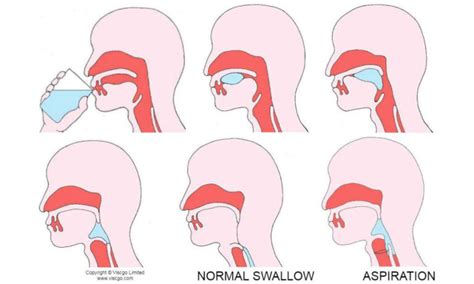 What Is Dysphagia Viscgo