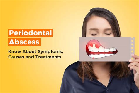 Periodontal Abscess: Know About Symptoms, Causes and Treatments