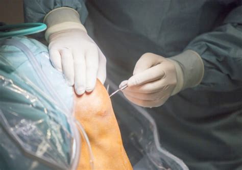 Patellar Tendon Surgery In 2024 - Dr. Pamela Mehta, San Jose