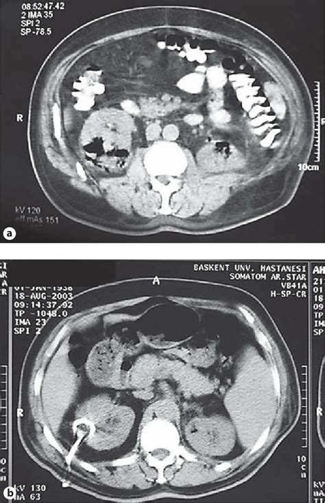 Figure From Tailored Treatment Approach For Emphysematous