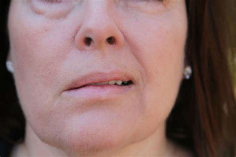 Bell's Palsy: 10 Bell's Palsy Symptoms