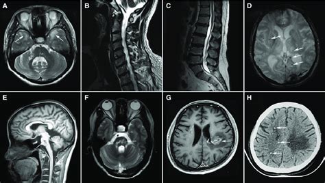 Characteristic Mri Features Of Genetic Cerebral Small Vessel Disease