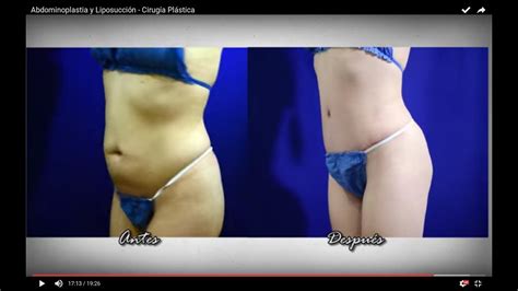 Abdominoplastia Y Liposucci N Cirug A Pl Stica Celular Whatsapp