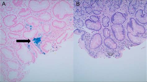 A Hematoxylin And Eosin Stain Of Gastric Glands Showed Irregularities Download Scientific