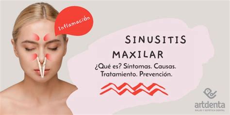 Sinusitis Maxilar Qué es Consecuencia bucodental Clínica Dental en