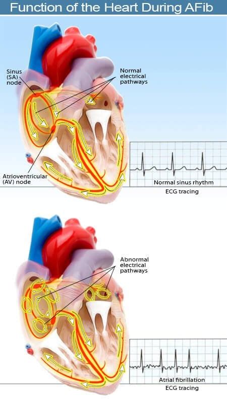 Atrial Fibrillation Vs Ventricular Fibrillation Which Is Worse