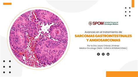 Sarcomas Avances En El Tratamiento De Sarcomas Gastrointestinales Y