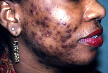 Post Inflammatory Hyperpigmentation – Pictures, Treatment, Causes