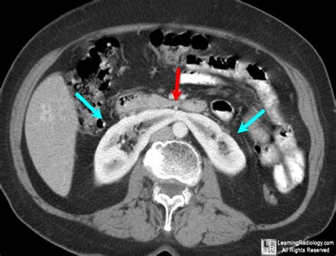 LearningRadiology - Horseshoe, Kidney