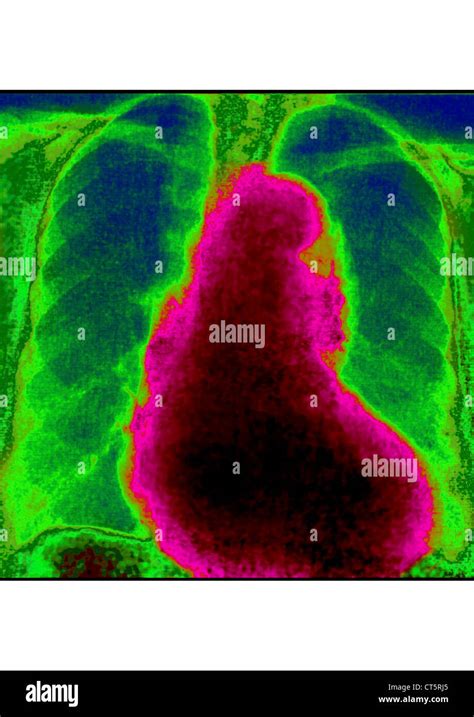 CARDIOMEGALY, X-RAY Stock Photo - Alamy