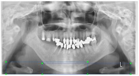 Eng Free Full Text A Basic Study For Predicting Dysphagia In