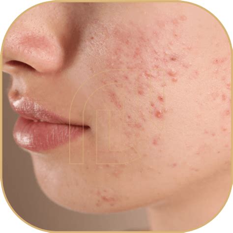 Acne Vulgar Clinica Novoa