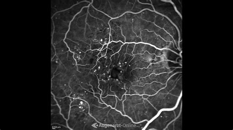 Diabetische Retinopathie Atlas Der Augenheilkunde