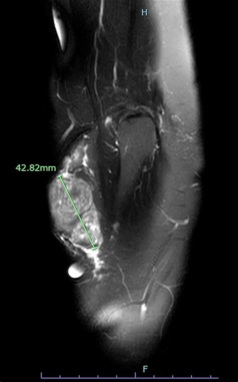 MRI of the right elbow joint revealed a 4.1 x 2.1 x 4.3 cm solid ...