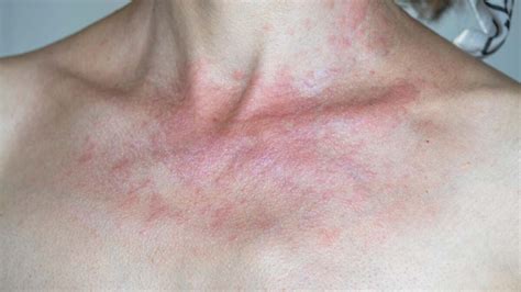 Your Rash Might Be a Sun Allergy | Lifehacker