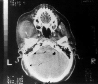 Axial CT image showing mass in the left infratemporal fossa. | Download Scientific Diagram