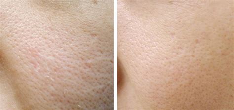 Laser Skin Resurfacing Pores