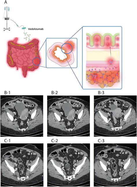 The Clinical Data Of The Case A Concomitant Presence Of Epiploic