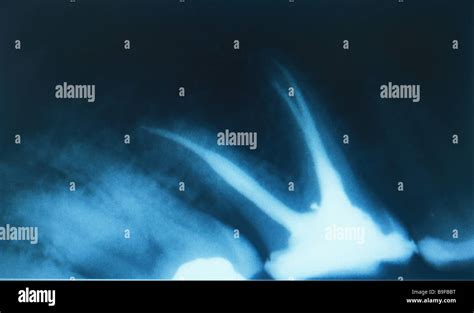 X-ray molar root-filling tooth roots roots filling filled teeth root ...