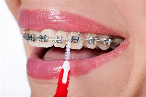 Brace Floss For Braces At Kathleen Arguello Blog