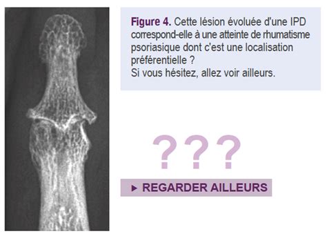 Arthropathies Interphalangiennes Distales Analyse L Mentaire Le