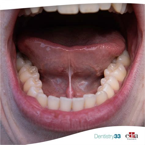 Ankyloglossia And Its Prevalence Dentistry33