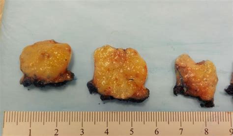 Pathology Outlines Case Of The Month 483