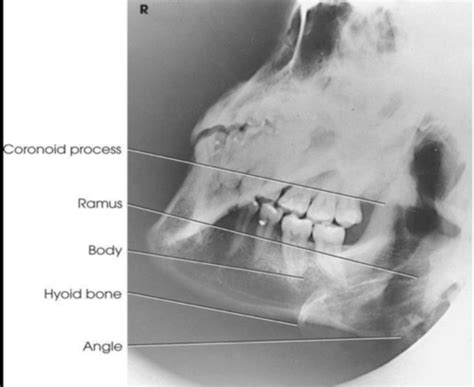 Extraoral Radiography Flashcards Quizlet